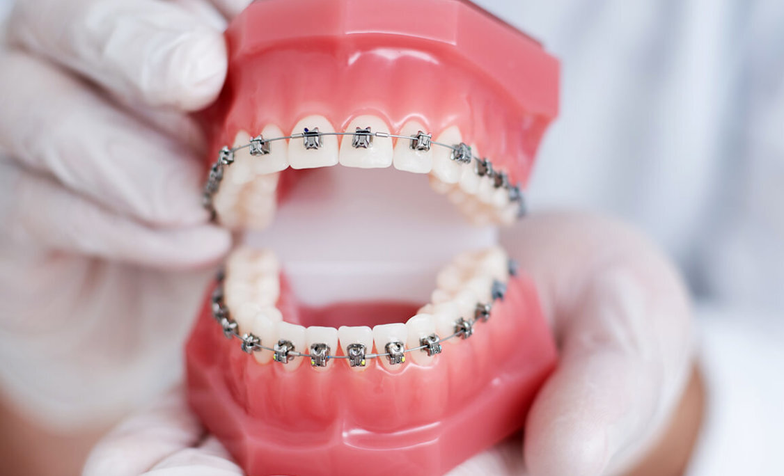 Why Getting Tooth Braces Makes Sense Even In 2022? 