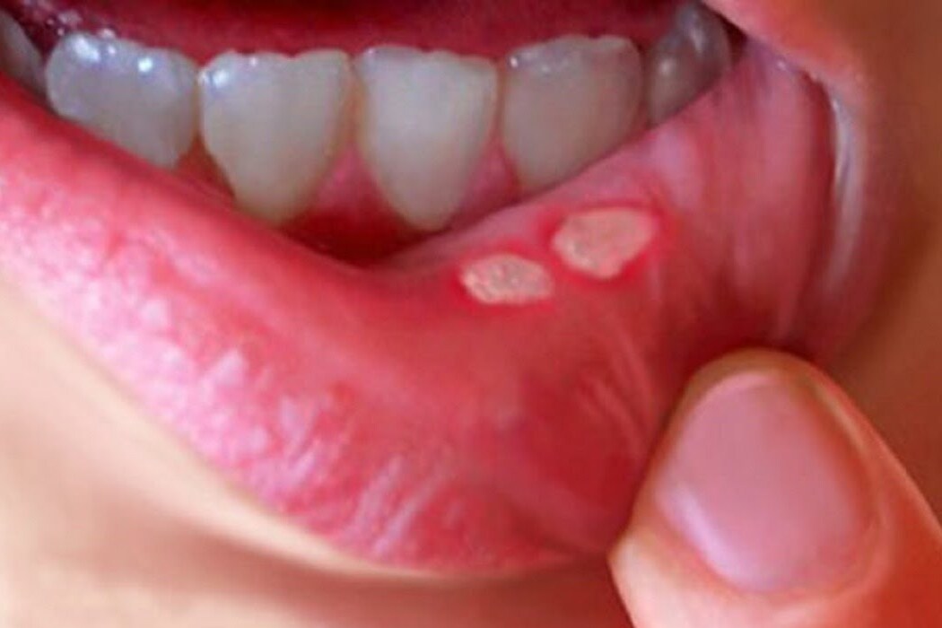 Did you know these things about mouth ulcers? Get your ulcers checked now 